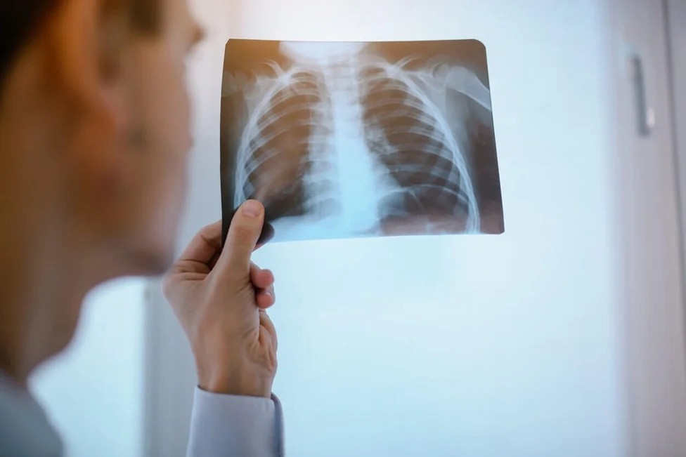 පෙනහළු ආසාදනයක් දරුණු වීමට පෙර පෙන්වන ලකුණු මොනවාද ?